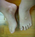 白癜风症状